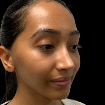 ethnic-rhinoplasty-after